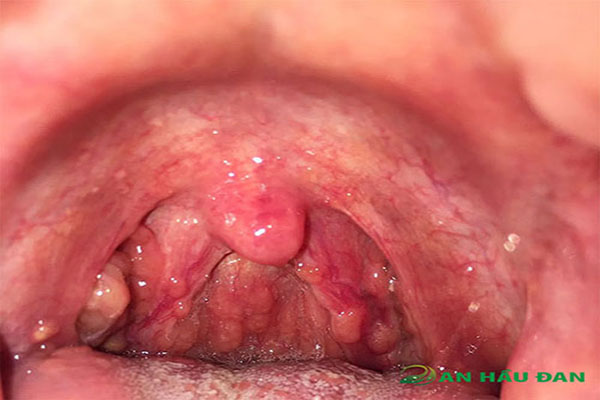 Viêm họng hạt cũng có thể là nguyên nhân gây vướng họng lâu ngày ở cổ