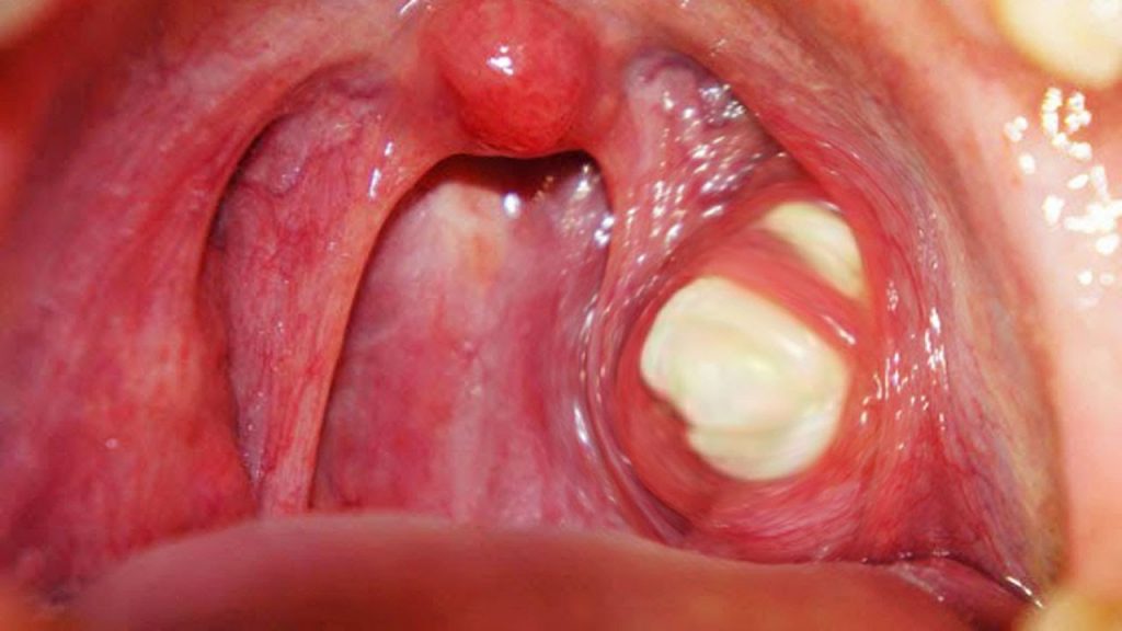 Tonsillitis Oral Sex Tonsils Chronic Cryptic Pictures