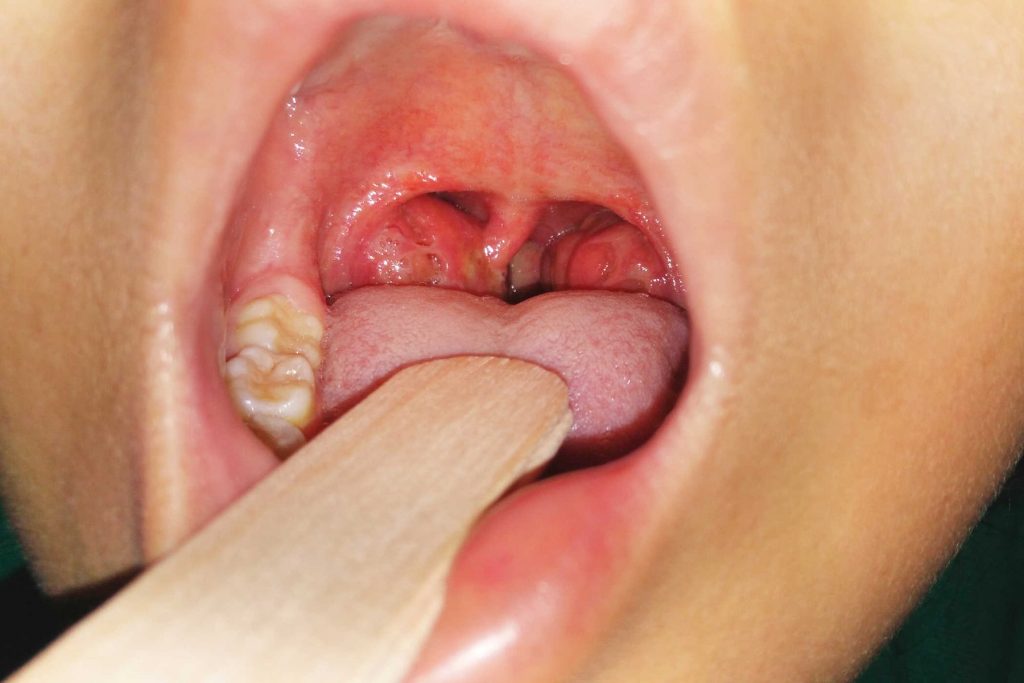 Viêm họng hạt không xử lý kịp thời có thể biến chứng thành áp xe họng