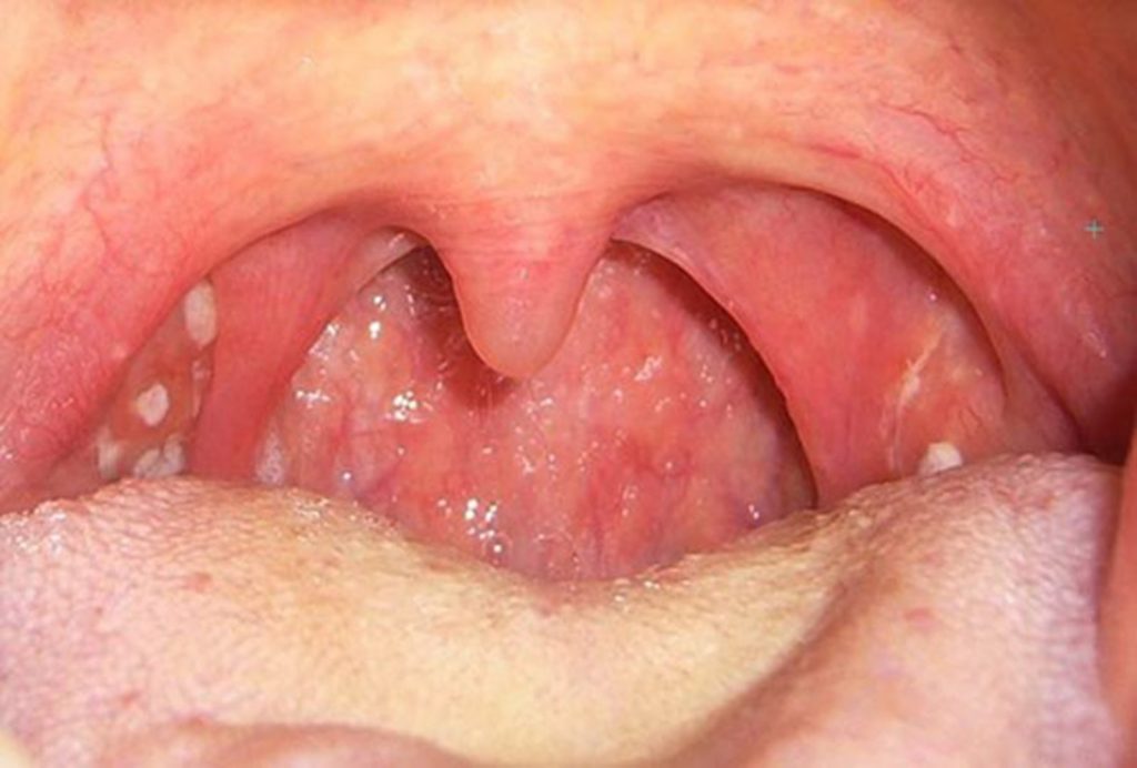 Viêm họng sưng hạch là dấu hiệu của viêm amidan