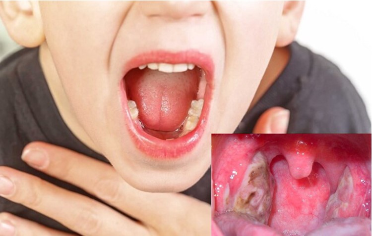 Nổi hạch dưới cằm là dấu hiệu ban đầu của bệnh ung thư vòm họng