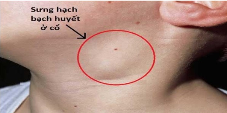 Nguyên nhân và cách phòng tránh bệnh sưng hạch bạch huyết ở cổ