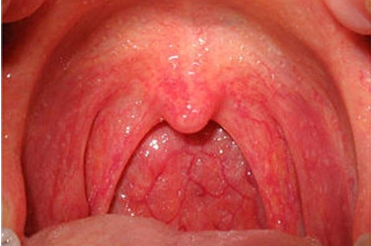 Viêm họng do vi khuẩn gây ra
