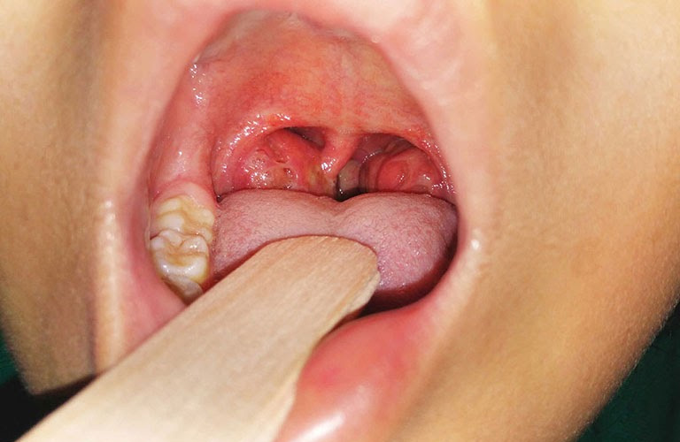 Nuốt nước bọt thấy vướng ở cổ họng có thể do viêm amidan gây ra