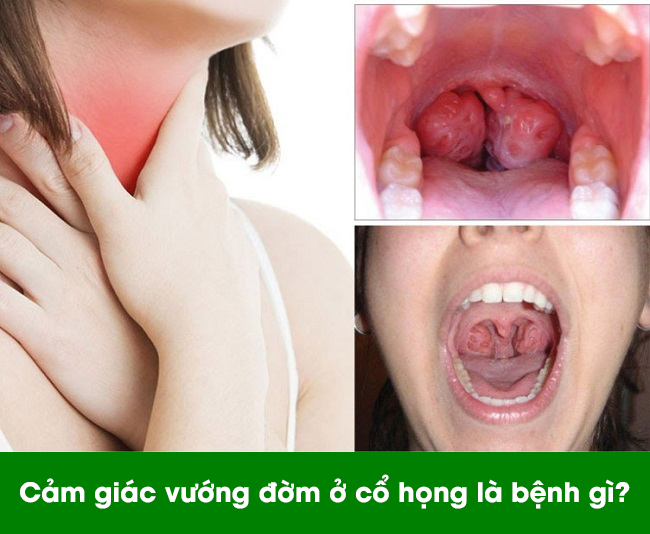 Cảm giác vướng đờm ở cổ họng là bệnh gì? Cách điều trị bệnh dứt điểm